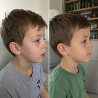 Two side-by-side profile photos of the same young boy, shown as a before-and-after comparison.