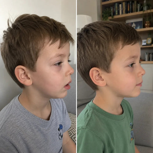 Two side-by-side profile photos of the same young boy, shown as a before-and-after comparison.